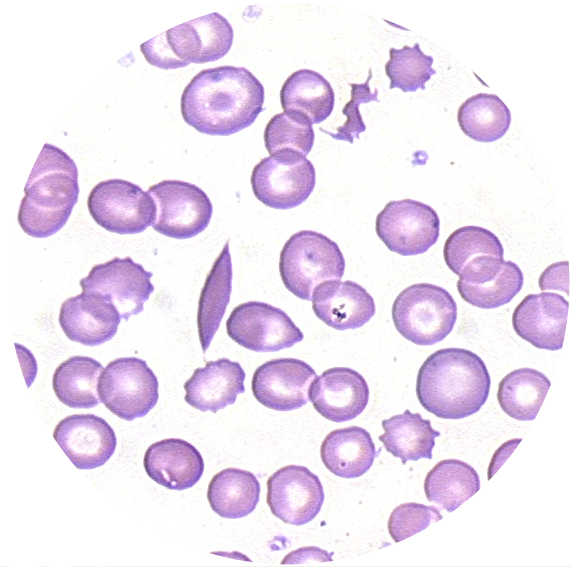 Polymorphic Rbc RBC Morphology Case Simulator